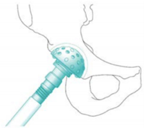 Acetabular-reaming-procedure