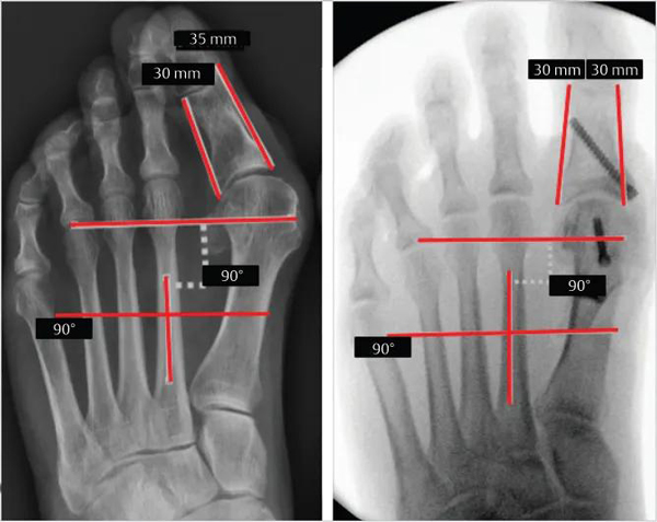 Hallux-valgus