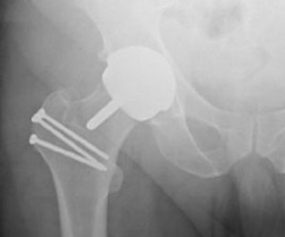 Hip-Resurfacing