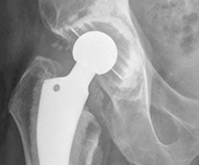 Partial Hip Replacement