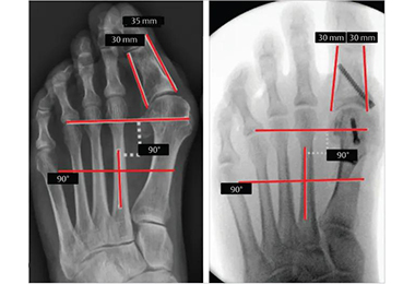 Minimally invasive hallux valgus surgery