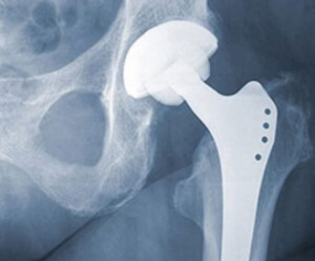 hip-replacement