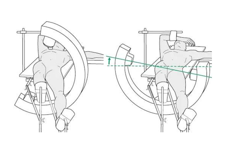 Femoral Intramedullary Nailing: Key Surgical Principles 